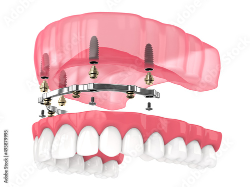 Bar retained removable overdenture installation supported by implants photo