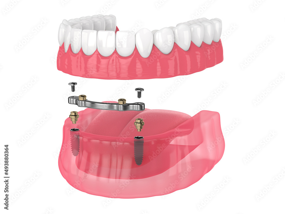 Bar retained removable overdenture installation supported by implants Stock Illustration Adobe