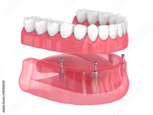 All-on-4 removable, implants supported, overdenture installation