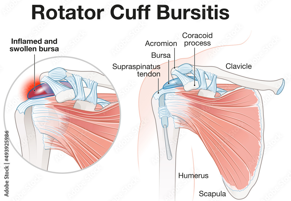 Photo & Art Print Rotator Cuff Bursitis Shoulder Illustration. Labeled ...