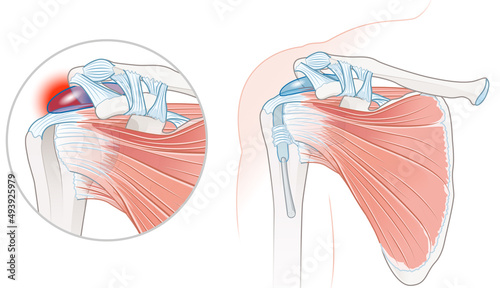 Obraz na płótnie Rotator Cuff Bursitis Shoulder Illustration. Labeled