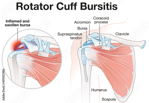 Foto Rotator Cuff Bursitis Shoulder Illustration. Labeled