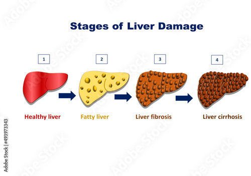 Stages of liver damage, liver injury steps Healthy, fatty liver steatosis, fibrosis and cirrhosis of liver. Vector illustration isolated on white background