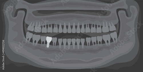 Black and white x-ray of human jaw with normal teeth and dental implant. Tooth after dental procedure. Surgical implant in oral cavity. Treatment, dentistry, health care. Radiograph with prosthesis