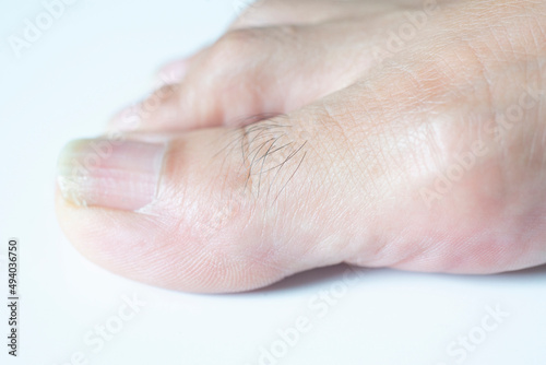 Hair on the skin surface of the toe.