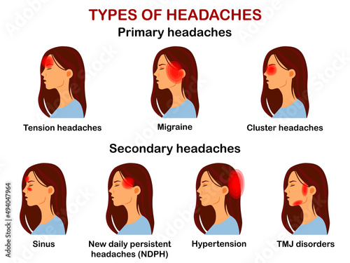 Types of headaches. Vector Infographic.