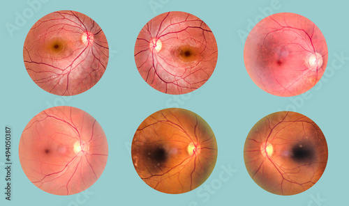 Konstfotografi View inside human eye disorders - showing retina, optic nerve and macula