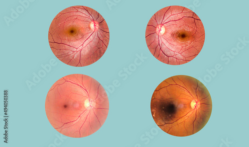 View inside human eye disorders - showing retina, optic nerve and macula.Retinal picture ,Medical photo tractional (eye screen) retinal detachment of diabetes.Eye treatment concept. photo