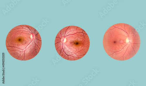 Obraz na plátne View inside human eye disorders - showing retina, optic nerve and macula