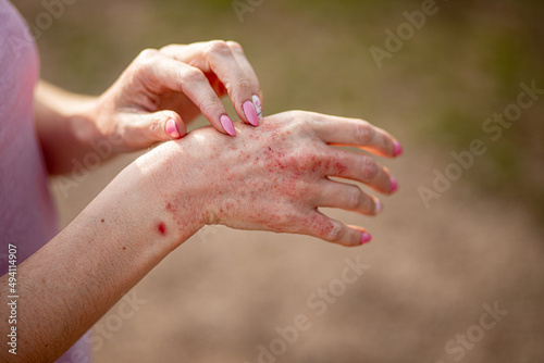 Close up dermatitis on skin, ill allergic rash eczema skin of patient , atopic dermatitis symptom skin detail texture , Fungus of skin ,The concept dermatology, treatment fungal photo