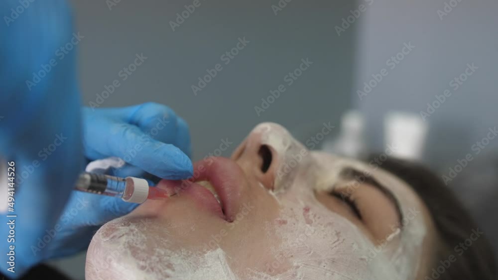 Female doctor, injecting hyaluronic acid into the patient's lips. Procedure for increasing the volume of lips, correction of lips shape. Close up
