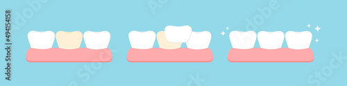 Tooth yellow color and tooth with veneer stage in gum. Teeth crown aesthetic treatment, cleaning, color restoration concept. Flat cartoon dental teeth ceramic reconstriction vector illustration.