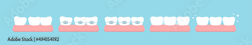 Tooth crooked, with dental braces stage, mouth guard in gym before after icon set. Dental braces on white teeth orthodontic bracket aesthetic correction treatment concept. Vector teeth illustration.