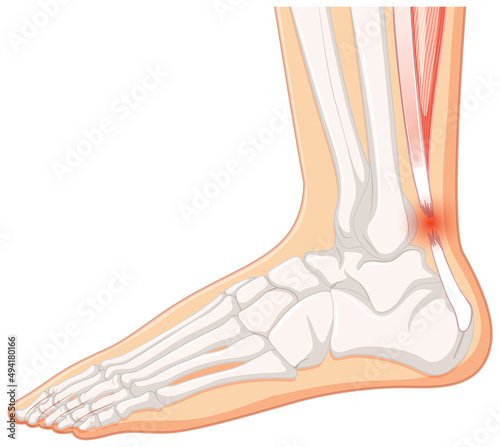 Achilles tendo rupture on white background