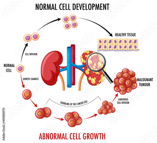 Diagram showing normal and cancer cell