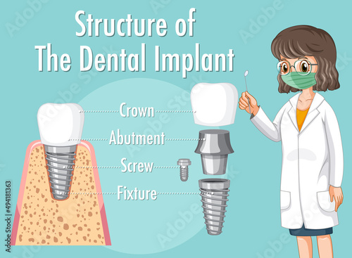 Infographic of human in structure of the dental implant
