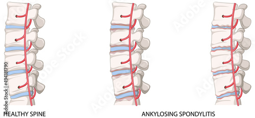 Infographic of healthy spine and ankylosing spondylitis