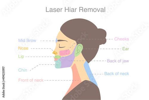 Highlight on woman's face area to do laser hair removal treatments. Illustration about diagram for a beauty treatment with laser.