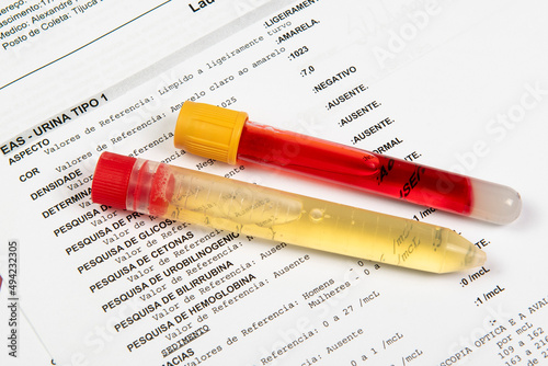 Test tube with urine analysis