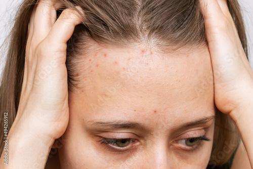 Cropped shot of a young woman's face with the problem of acne. Pimples on the forehead. Allergies, red rash, hormonal changes. Problem skin, care and beauty concept. Dermatology, cosmetology photo