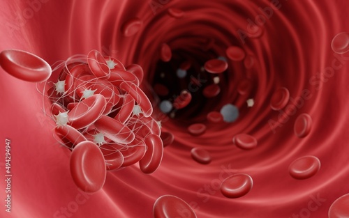 Blood clots (fibrin clots) are usually formed to stop the bleeding during injury, Blood clots can be dangerouse when they obstruct blood flow and cause thrombosis