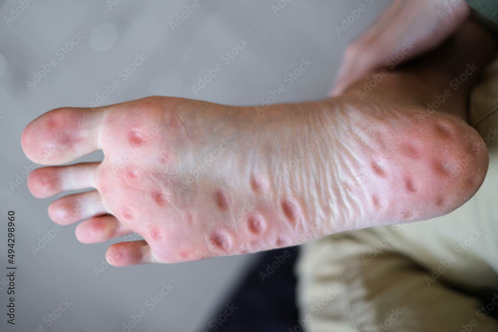 traces from a massager with spikes on the soles of the feet close-up. acupuncture traces from a massager with spikes on the soles of the feet close-up. acupuncture