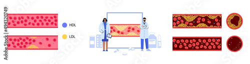 Cholesterol blood artery