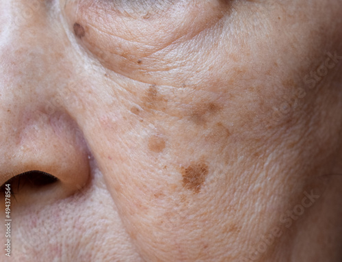 Small brown patches called age spots on face of Asian elder woman. They are also called liver spots, senile lentigo, or sun spots. photo