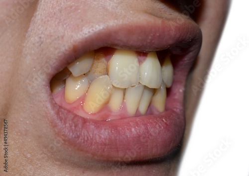 Принти на полотні Stacked or overlapping teeth with yellow stain