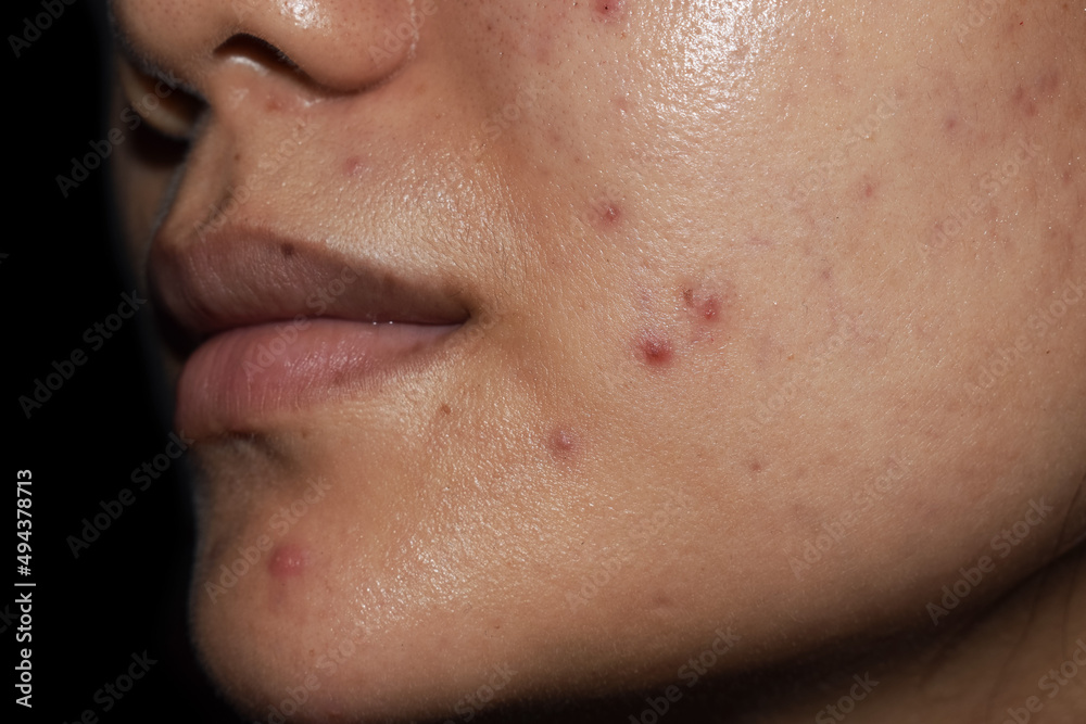 Obraz premium Acne, red spots and scars on face