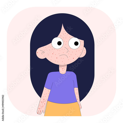 Little girl baby kids face sick chickenpox virus infographics icon design. Vector flat character illustration. Looking reach of children which has symptoms of smallpox chickenpox.