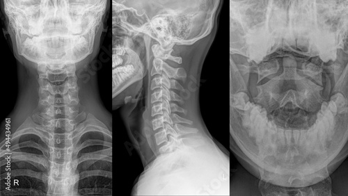 cervical spine of a patient in different projection..