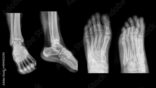 adult foot and ankle x-ray film.