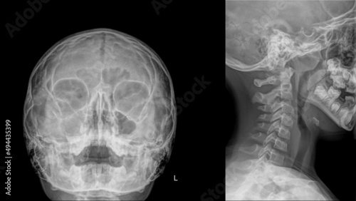 Paranasal sinus x-ray of a child with chronic sinusitis and adenoid vegetation.. photo