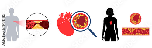Cholesterol heart disease