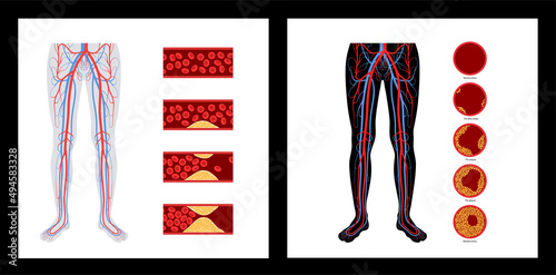 Peripheral artery disease