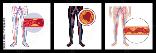 Peripheral artery disease