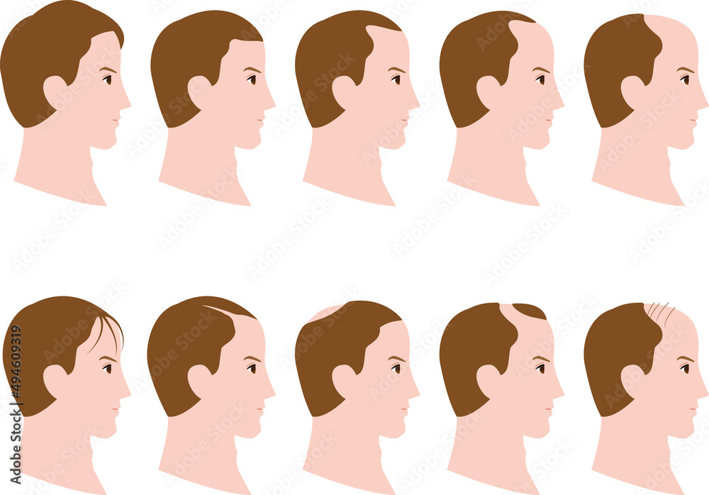 横顔の男性の毛量の増減するイラスト 横顔の男性の毛量の増減するイラスト