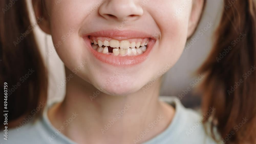 Close-up smile face of a child girl. A beautiful little girl 7-8 years old has lost milk teeth. Loss of milk teeth, replacement of permanent teeth. Children is dentistry Close-up smile face of a child girl. A beautiful little girl 7-8 years old has lost milk teeth. Loss of milk teeth, replacement of permanent teeth. Children is dentistry