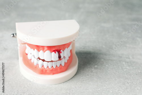 Model of jaw with blood on light grey table, space for text. Gum inflammation photo