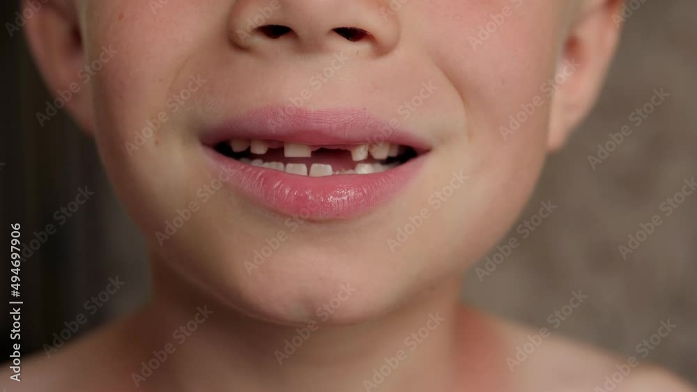 A close-up of a little boy shows his fallen out baby teeth. Change of teeth in children. A close-up of a little boy shows his fallen out baby teeth. Change of teeth in children.