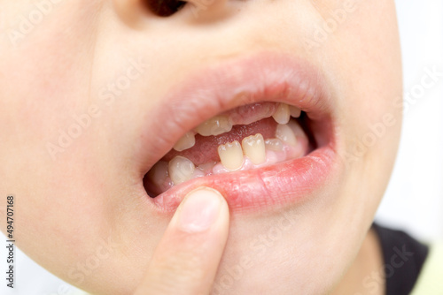 日本人の子供の抜け落ちた乳歯