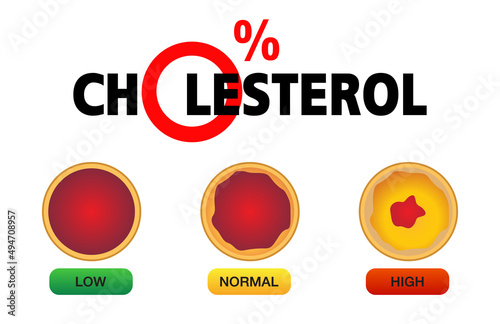 Cholesterol in artery, health risk , vector design