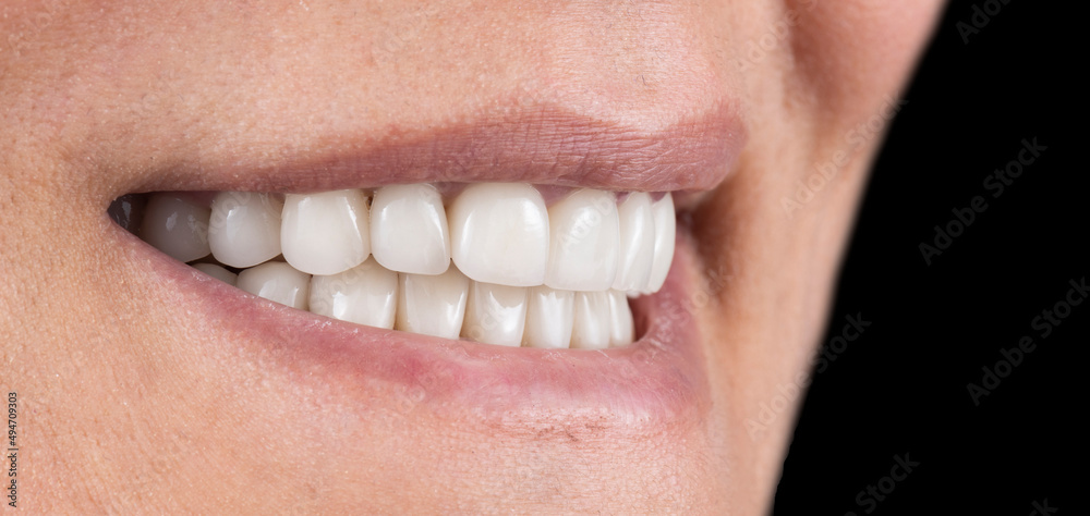 Obraz premium ceramic teeth with natural look and shape