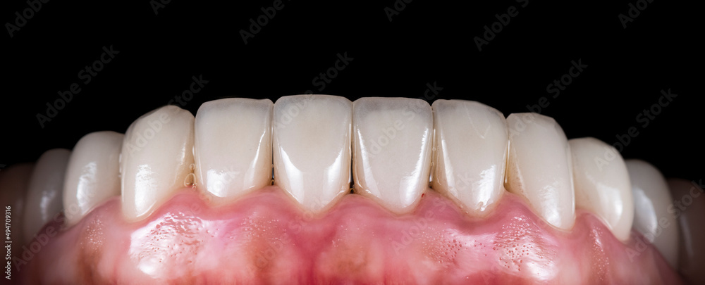 crowns and venners b1 color crowns and venners b1 color