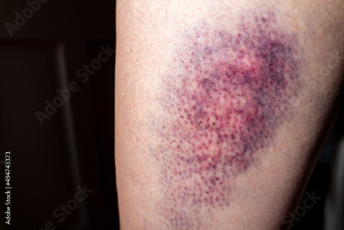 Terrible bruise on the upper leg of a woman
