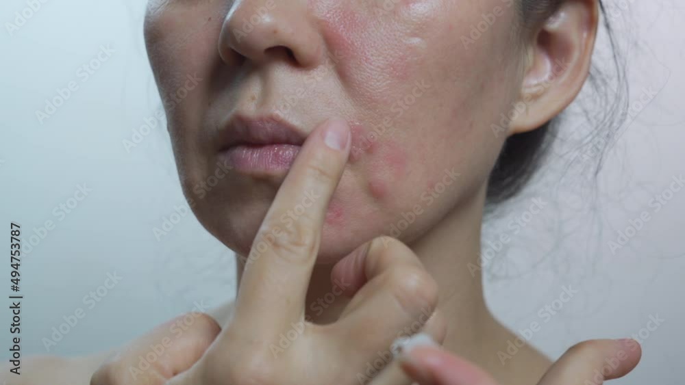 Acne on the chin: demodicosis mite on the skin of the girl's face. Acne on the chin: demodicosis mite on the skin of the girl's face.