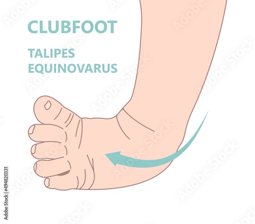Equinovarus W sit injury bow leg genu valgum varum flat duck out turn inward varus club skew birth in toeing child baby kids knock knees slew foot valgus ankle palsy hip pain