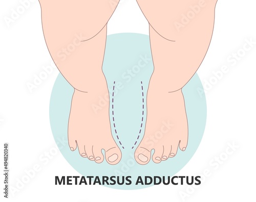 Disorders W sit injury bow leg genu valgum varum flat duck out turn inward varus club skew birth in toeing child baby kids knock knees slew foot valgus ankle palsy hip pain