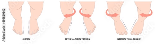 Disorders W sit injury bow leg genu valgum varum flat duck out turn inward varus club skew birth in toeing child baby kids knock knees slew foot valgus ankle palsy hip pain